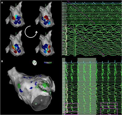 Structural Remodeling and Rotational Activity in Persistent/Long-Lasting Atrial Fibrillation: Gender-Effect Differences and Impact on Post-ablation Outcome